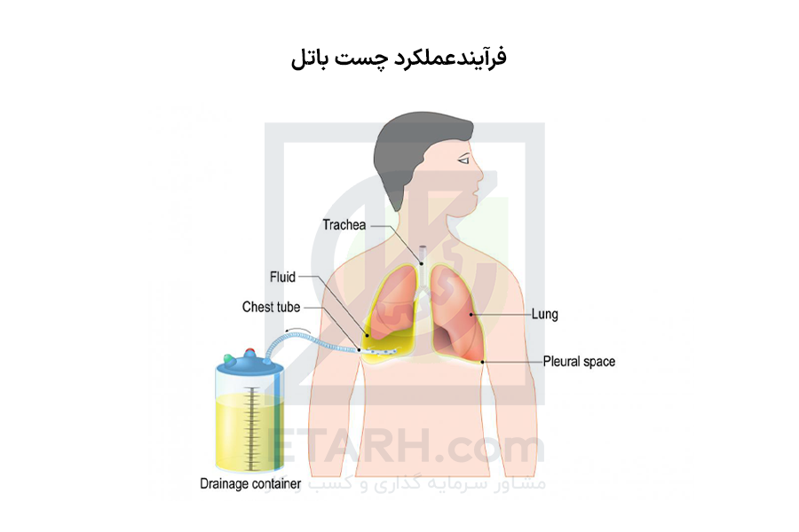 فرایند عملکرد چست باتل